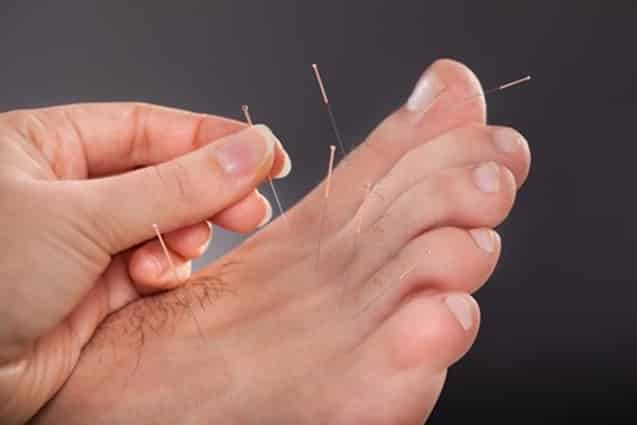 Benefits of dry needling therapy